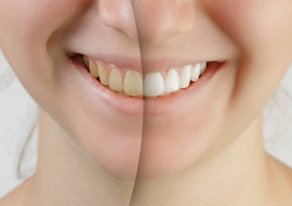 Stock image of female showing yellow teeth on one side and whiter teeth on other side