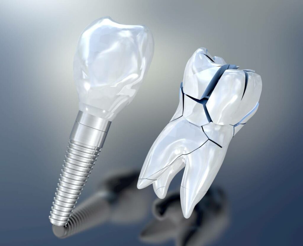 Can You Fix a Broken Crown? GLO Modern Dental Blog