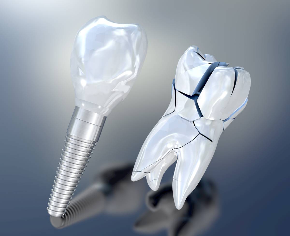 Can You Fix A Broken Crown GLO Modern Dental Blog