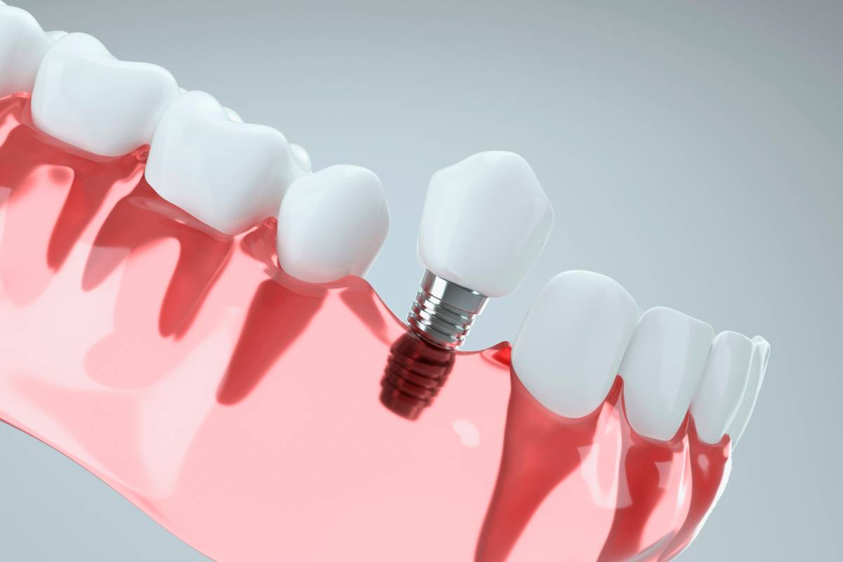 featured image for article on four reasons to invest in dental implants