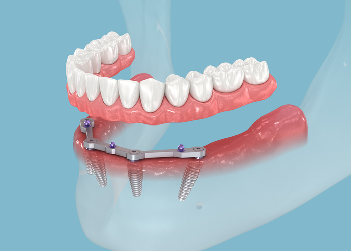 Featured image for Can You Wear Dentures Over Your Dental Implants