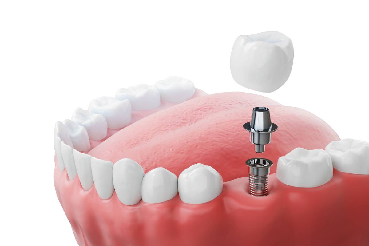 Featured image for Do Dental Implants Hurt?