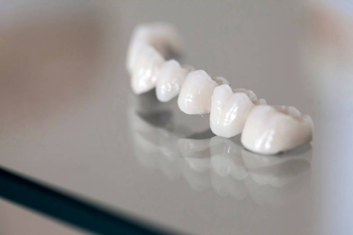 featured image for article on is a dental bridge permanent